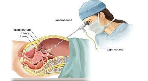 
Ngoài chẩn đoán, phương pháp còn có thể sửa chữa những tổn thương như khâu vỡ ruột non, bàng quang....
