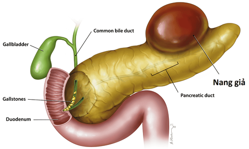 Pancreatic pseudocyst: Complications and treatment