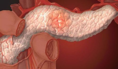 Possible complications of chronic pancreatitis