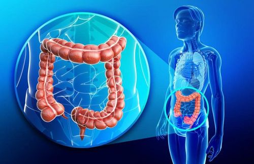 When is laparoscopic colectomy indicated?