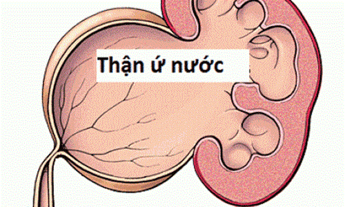 
Thận móng ngựa có thể gây ra những biến chứng tắc nghẽn đường tiểu, ứ nước thận
