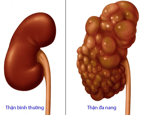 
Hình ảnh thận đa nang và thận bình thường
