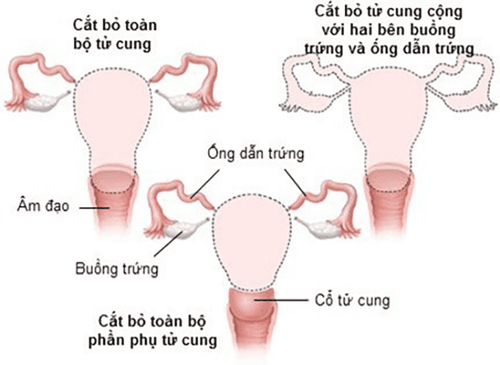 
Dựa trên tình trạng bệnh, bác sĩ lựa chọn phương pháp cắt bỏ tử cung hợp lý
