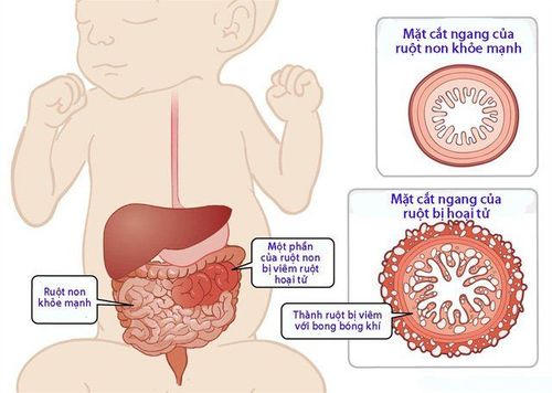 
Viêm đường ruột là một trong các nguyên nhân gây tiêu chảy ở trẻ sơ sinh
