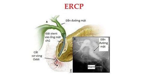 
Bác sĩ có thể khuyên người bệnh nên làm thủ thuật ERCP để điều trị vàng da tắc mật
