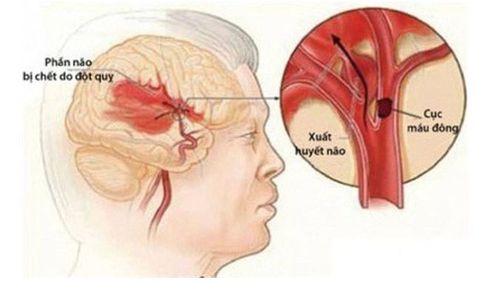 
Đột quỵ não là căn bệnh rất nguy hiểm với tỷ lệ mắc bệnh càng ngày càng cao
