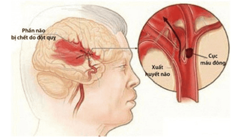 
Nhồi máu não là nguyên nhân chủ yếu gây đột quỵ não
