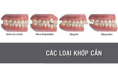 
Các loại khớp cắn
