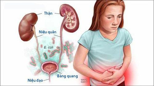 Urinary tract infections in children