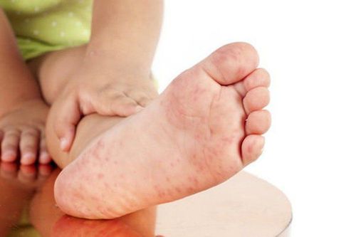 Hand, foot and mouth disease: Signs suggest the risk of complications