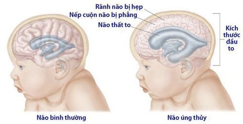 
Não úng thủy là tình trạng dư thừa một loại chất lỏng trong não mà từ chuyên môn gọi là dịch não tủy
