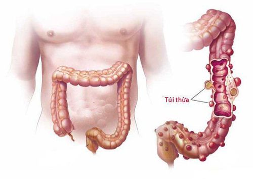 
Viêm túi thừa đại tràng là gì?
