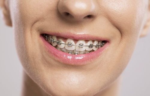 Why are metal braces still popular?