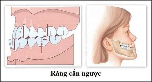 What kind of teeth are considered backward bite?