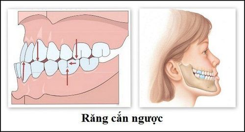 
Hình ảnh mô phỏng khớp cắn ngược
