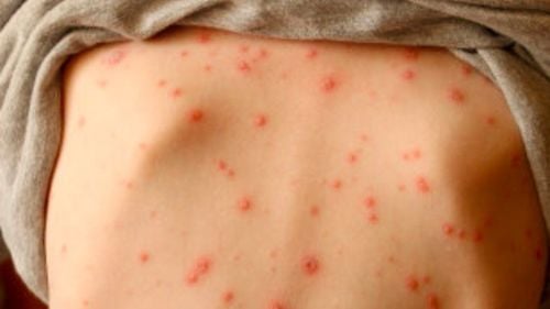 Do scars after chickenpox heal on their own?