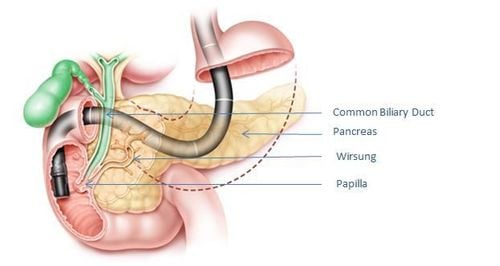 
Nội soi ERCP là phương pháp được dùng để cắt các cơ trong ống mật chủ
