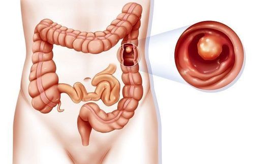 
Hình ảnh bị polyp hậu môn trực tràng
