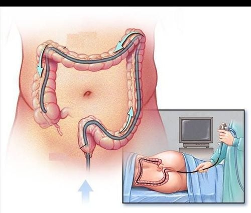 
Nội soi ống tiêu hóa dưới, trực tràng và đại tràng
