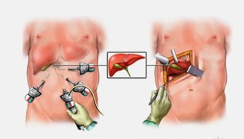 
Nội soi là phương pháp được dùng khi mổ sỏi mật
