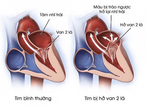 
Chụp x-quang chẩn đoán bệnh hở van tim
