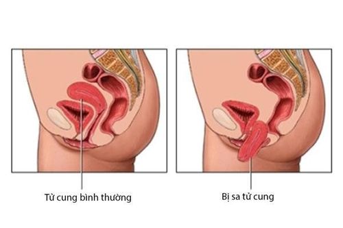 
Sa sinh dục ở phụ nữ
