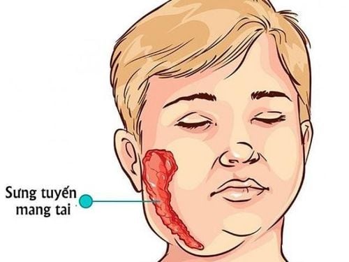 Does every mumps patient have fever and lymphadenopathy?