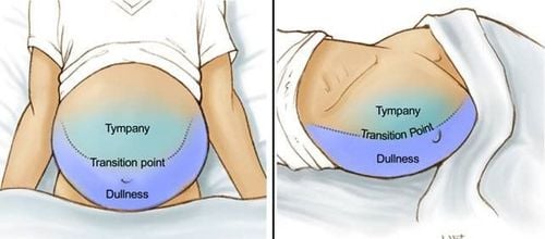 Diagnosis of peritoneal effusion