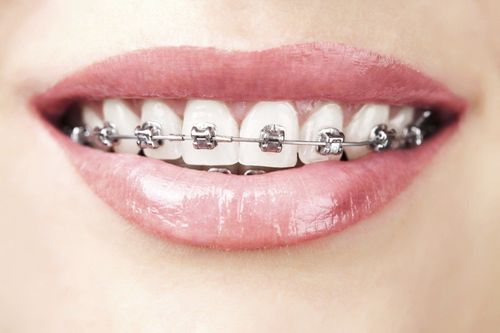 Why is it necessary to wear an elastic band when wearing braces?