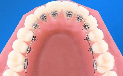 Braces with braces on the inside and what you need to know