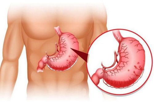 How to deal with repeated gastrointestinal bleeding?