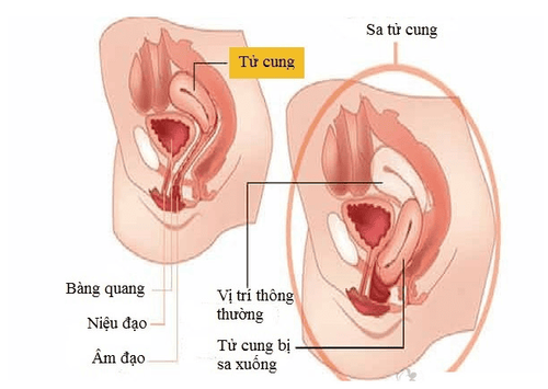 
Hình ảnh sa tử cung
