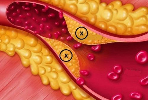 Identify the causes of dyslipidemia