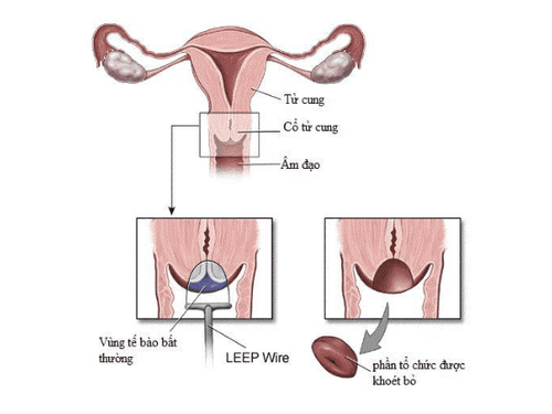 Possible risks after cervical cone surgery