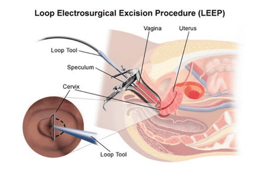 Electric ring cones for the treatment of early cervical cancer