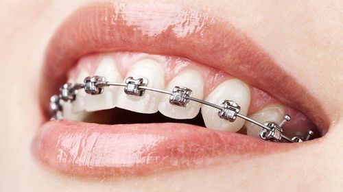 Pros and cons of conventional and self-ligating metal braces