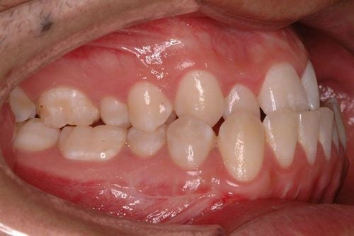 Trẻ bị khớp cắn ngược khi thay răng, phải làm thế nào?