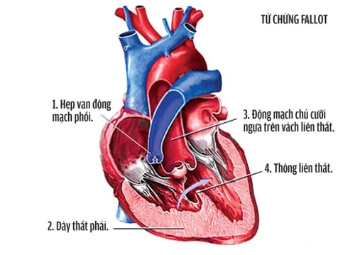 
Tổn thương của tứ chứng Fallot
