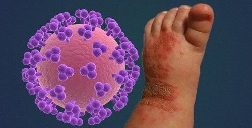 
Nhiễm virus Herpes là dấu hiệu trên da của trẻ bị HIV
