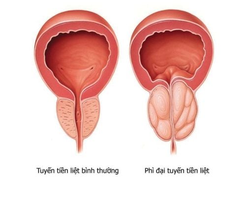 
Mối liên quan giữa chỉ số PSA và ung thư tiền liệt tuyến
