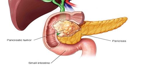 Learn about the cancer marker CA 19-9