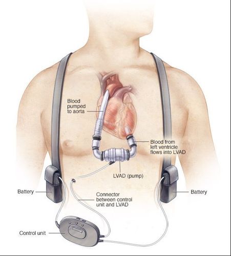 
Dụng cụ hỗ trợ tim cơ học LVAD được phát triển để trở thành một lựa chọn sống còn cho những bệnh nhân suy tim giai đoạn cuối
