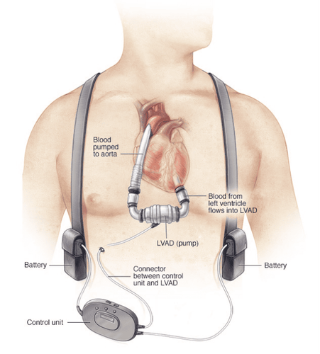 
Dụng cụ hỗ trợ tim cơ học LVAD được phát triển để trở thành một lựa chọn sống còn cho những bệnh nhân suy tim giai đoạn cuối
