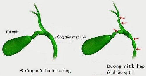 
Bệnh nhân sau phẫu thuật cần được tái khám thường xuyên để sớm phát hiện các triệu chứng chít hẹp đường mật tái phát
