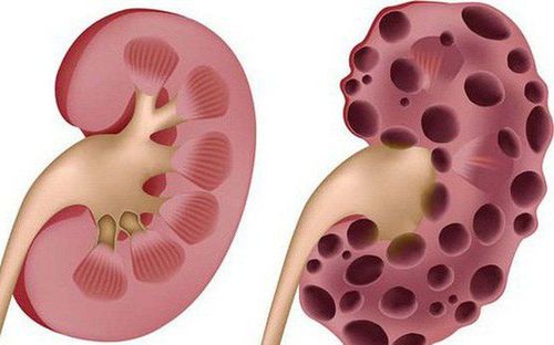 Diagnosing kidney failure in diabetics