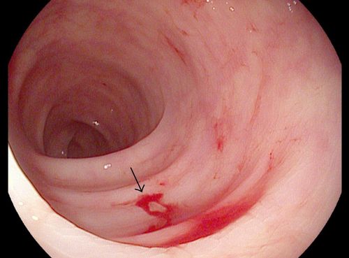 Colonoscopy finds abnormalities in large intestine and rectum