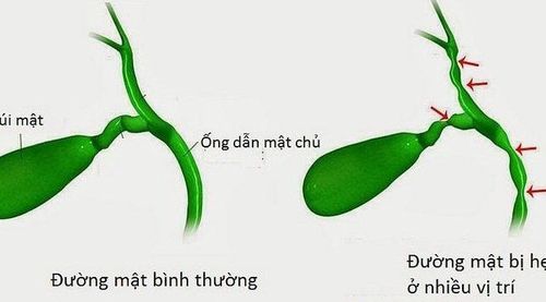 Bệnh teo đường mật bẩm sinh có thể điều trị ghép tế bào gốc không?