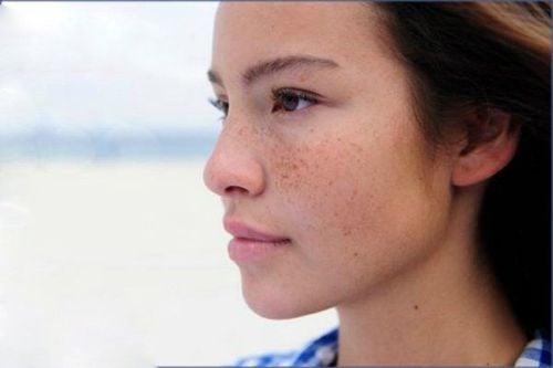 Melasma due to hormonal disorders