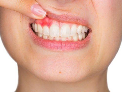 Notes in the treatment and prevention of gingivitis