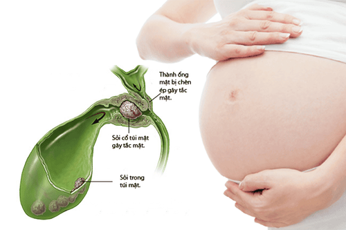 Bị sỏi túi mật khi mang thai: Những điều cần biết